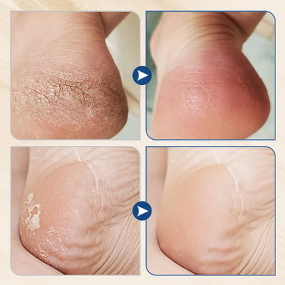 🔥Winter Hot Sale 49%OFF- Hydrating and Anti-Cracking Foot Cream(Autumn/Winter Essential)